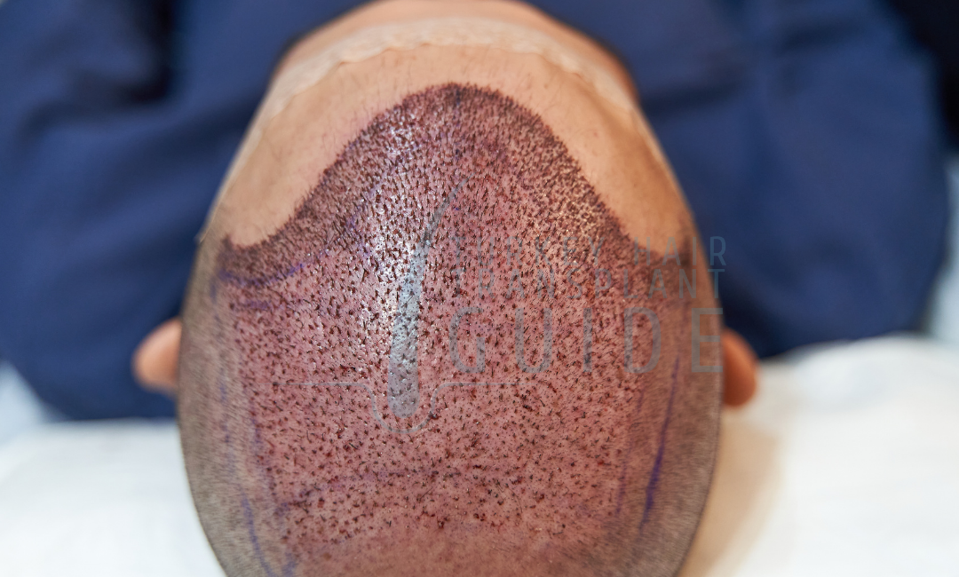 what is a hair transplant