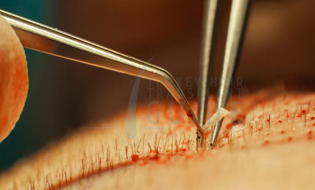 Types of Hair Transplant Techniques in Turkey | Sapphire FUE, DHI & Hybrid Explained 35 Types of Hair Transplant Techniques in Turkey