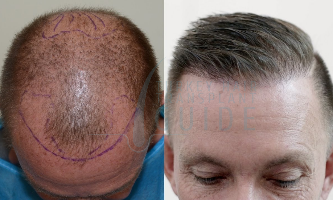 after hair transplant 1 year
