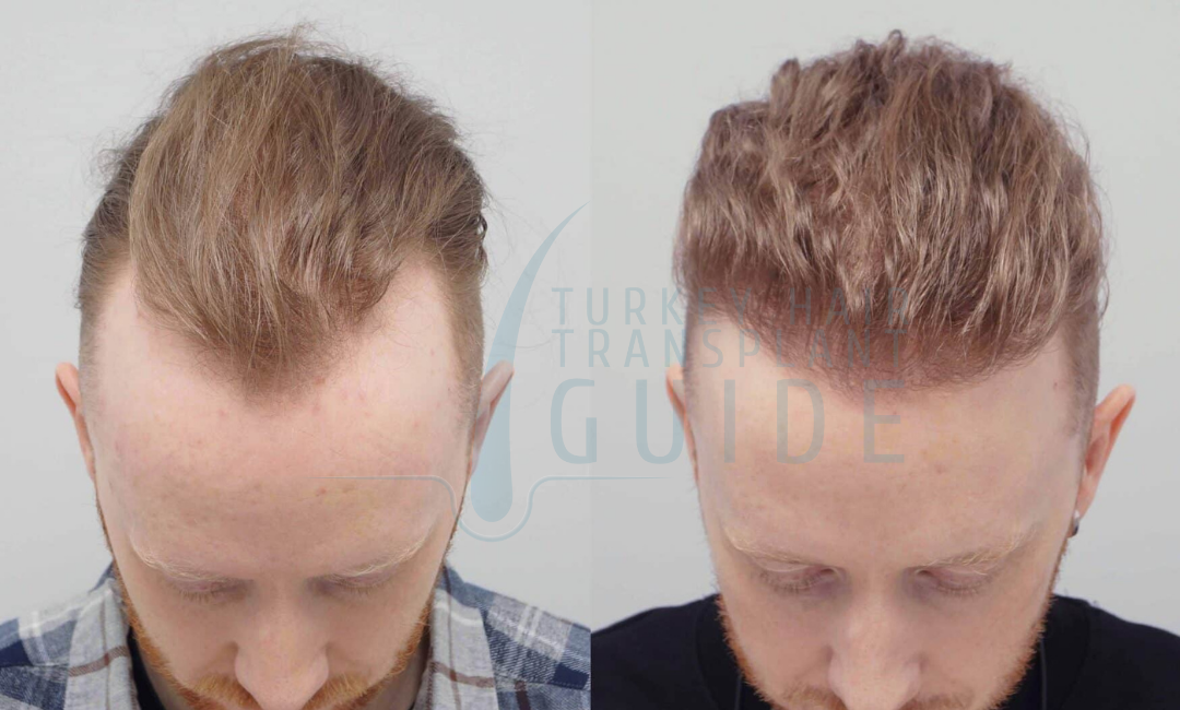 after hair transplant