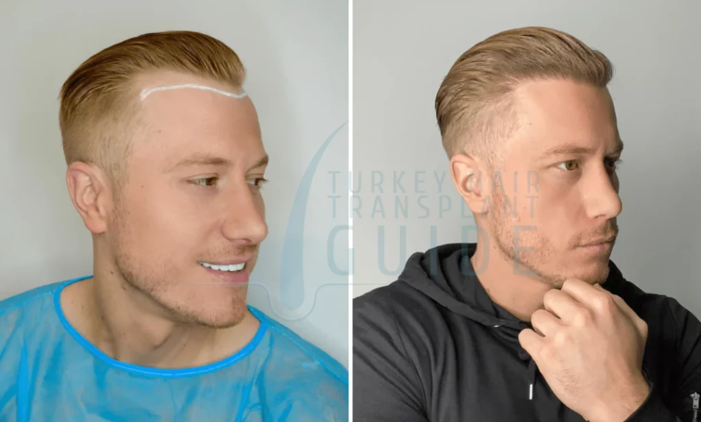 What to Expect After a Hair Transplant | 1 Month, 3 Months & 1 Year Recovery Timeline 1 after hair transplant