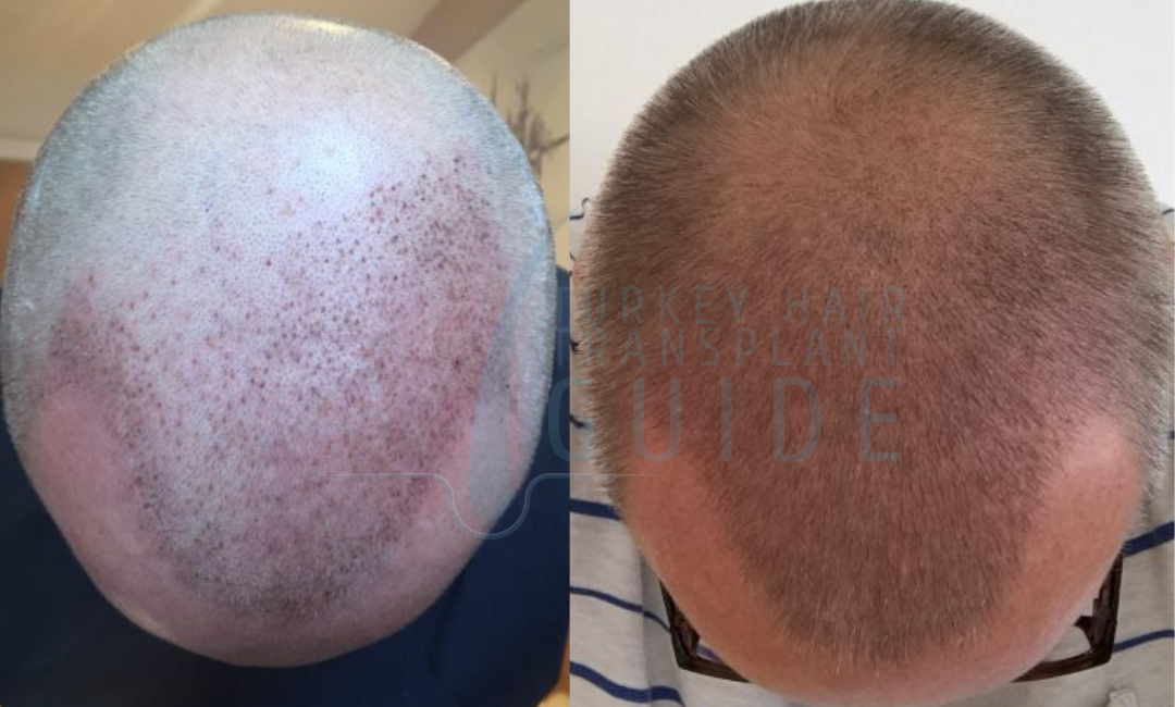 after hair transplant week