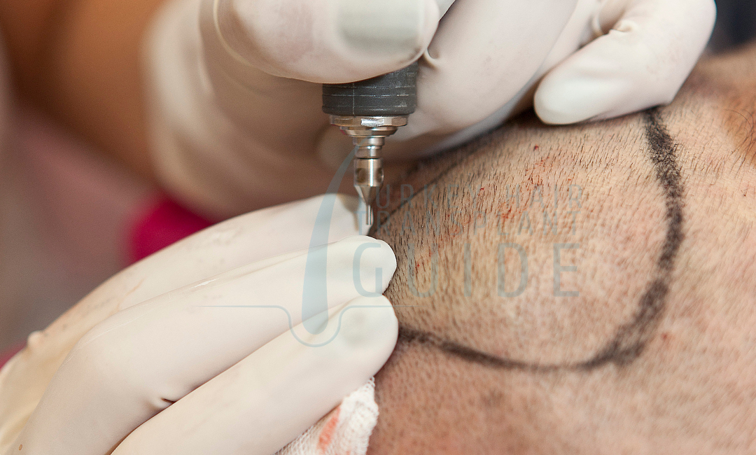 extraction and implantation