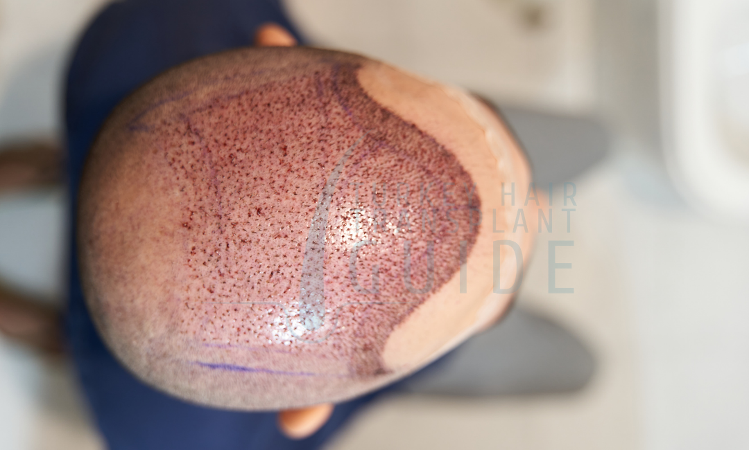 hair transplant in istanbul