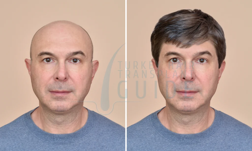 Hair Transplant vs Hair Replacement – Which Is Better? | Comparing Surgical & Non-Surgical Options 4 hair transplant or replacement fi