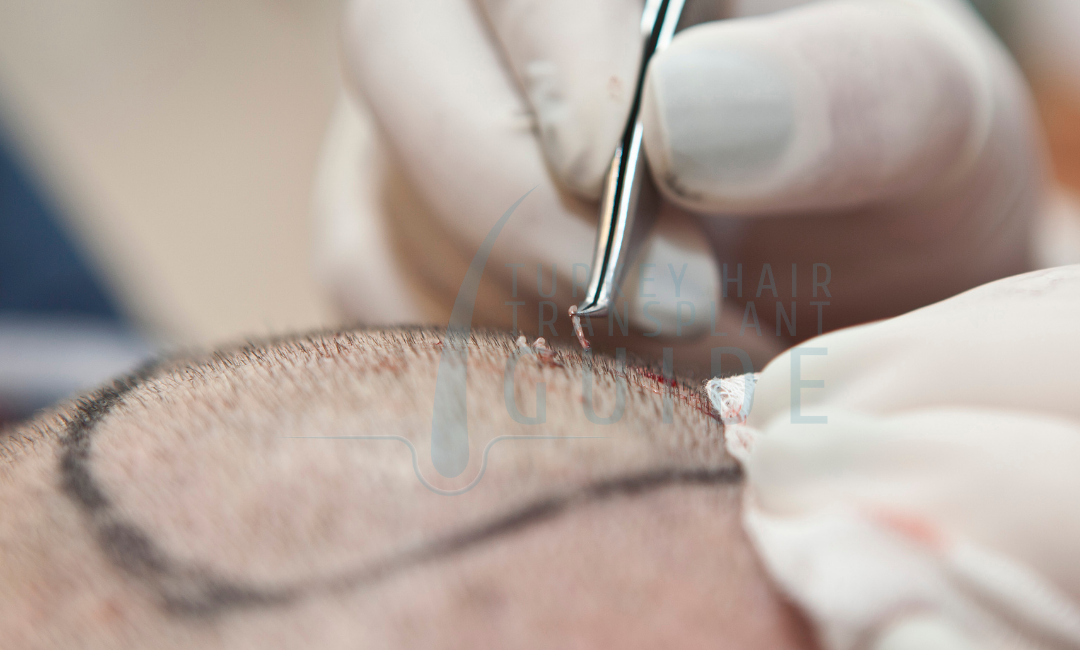 hair transplant techniques or replacement wigs