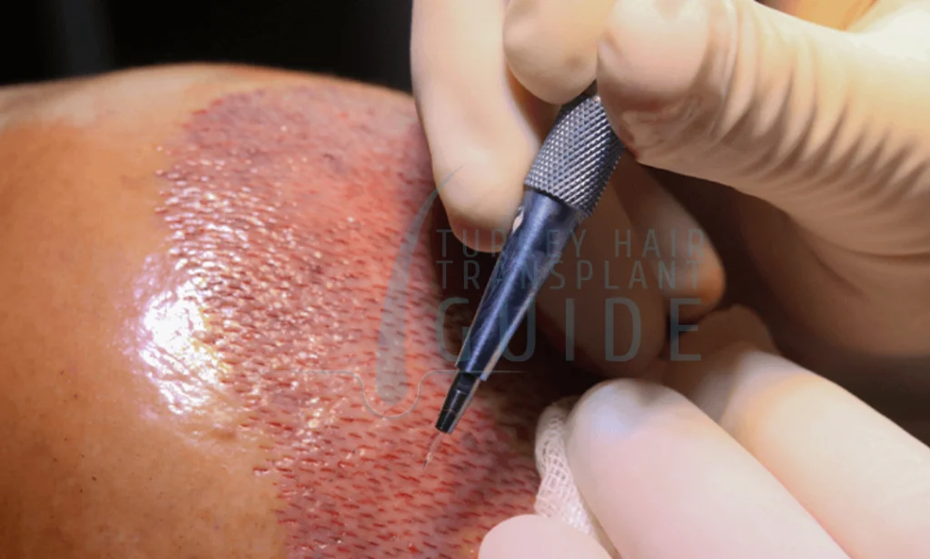 Sapphire FUE Hair Transplant in Turkey | Advanced Hair Restoration Technique 30 sapphire fue hair transplant in turkey fi
