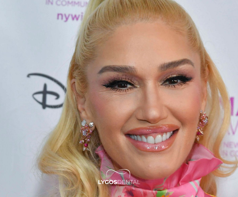 Gwen Stefani Diş Kaplamaları | LYGOS DENTAL
