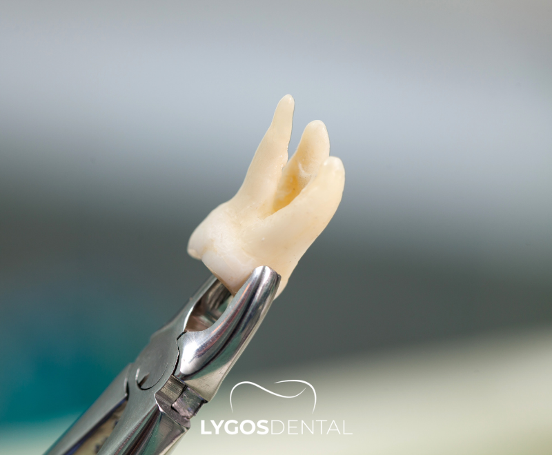 Horizontal Impacted Wisdom Tooth | LYGOS DENTAL