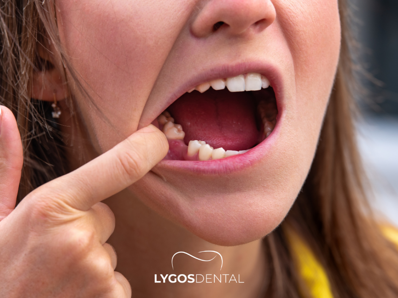 ¿Qué sucede si se traga un diente? | LYGOS DENTAL