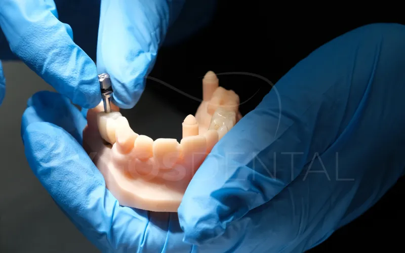 Advanced Dental Implants